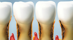 Periodontoloji (Diş Eti Hastalıkları)